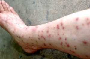 Expert-Pest-Control-Fleas-Ticks-Springfield-Missouri-infected-bites